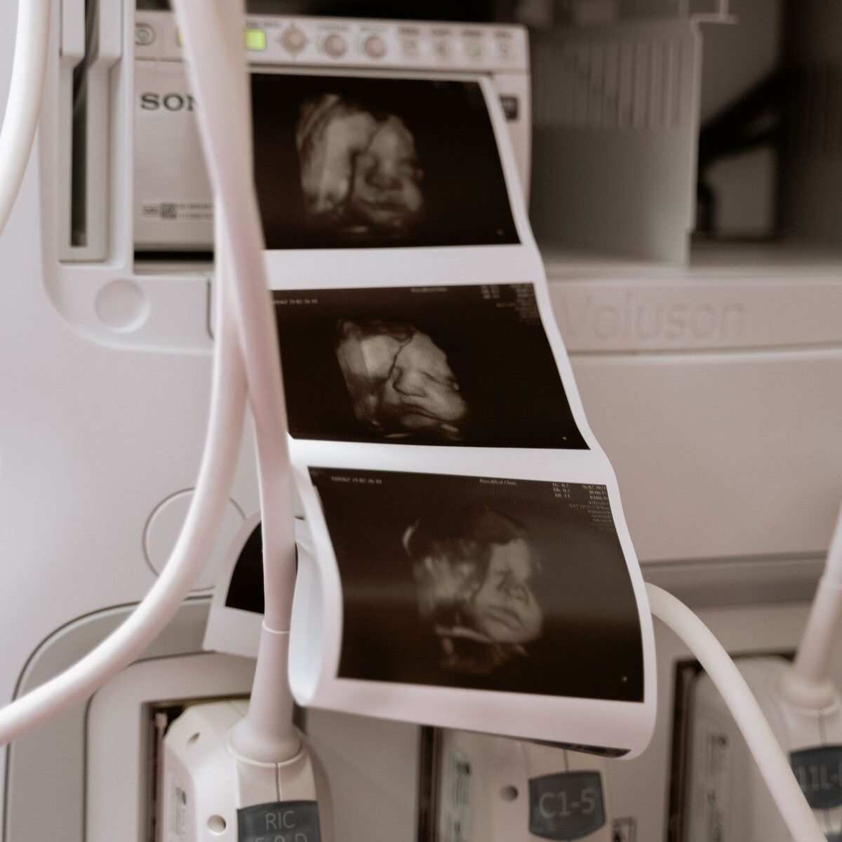 Warum das Ersttrimester-Screening mehr ist als ein Ultraschallbild